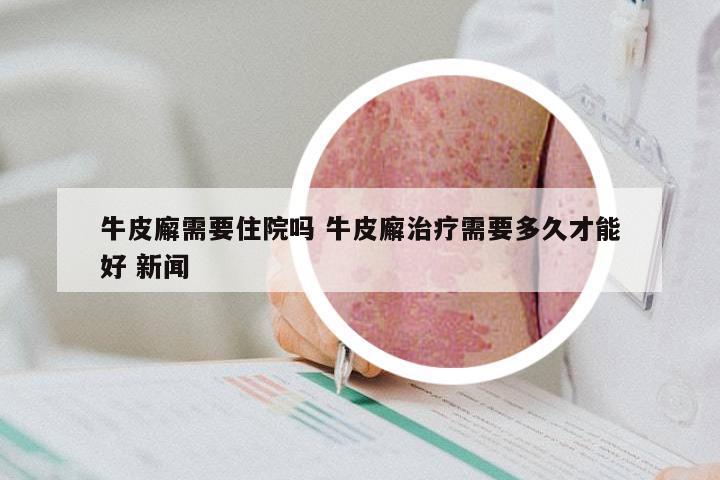 牛皮廨需要住院吗 牛皮廨治疗需要多久才能好 新闻