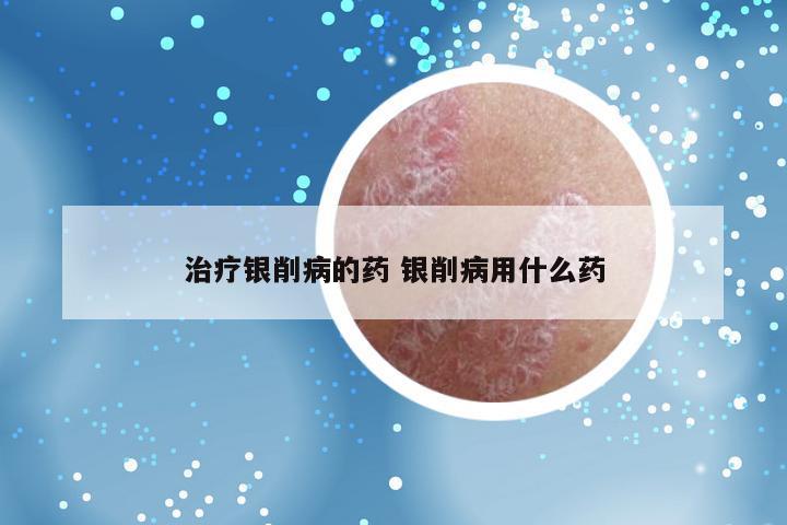 治疗银削病的药 银削病用什么药