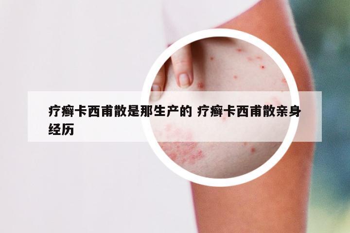 疗癣卡西甫散是那生产的 疗癣卡西甫散亲身经历