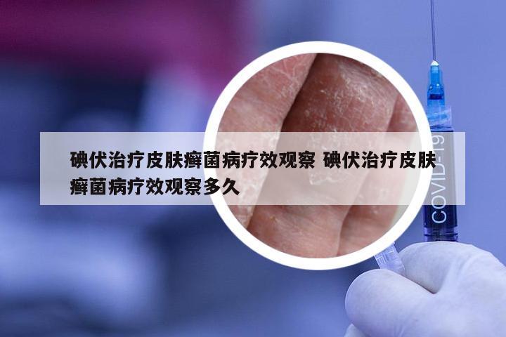 碘伏治疗皮肤癣菌病疗效观察 碘伏治疗皮肤癣菌病疗效观察多久