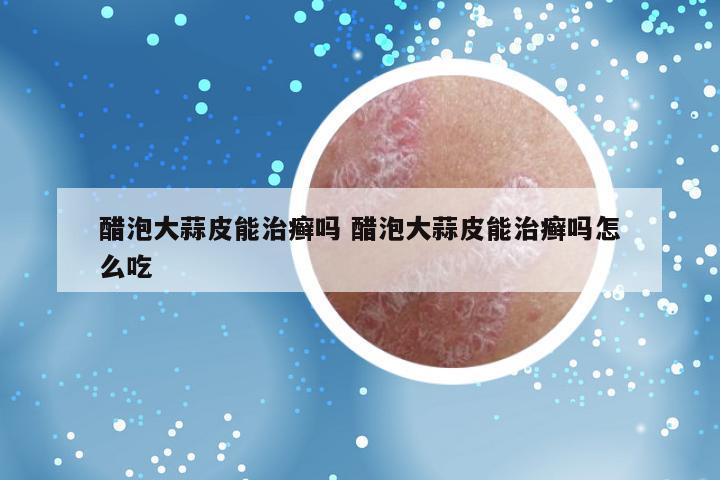 醋泡大蒜皮能治癣吗 醋泡大蒜皮能治癣吗怎么吃
