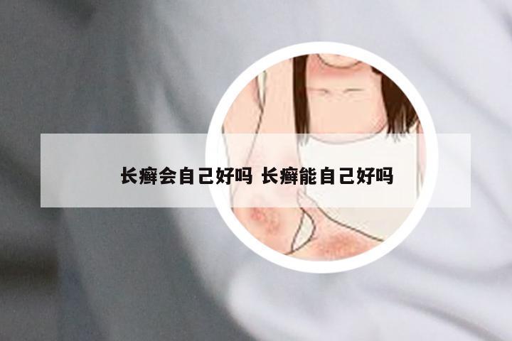 长癣会自己好吗 长癣能自己好吗