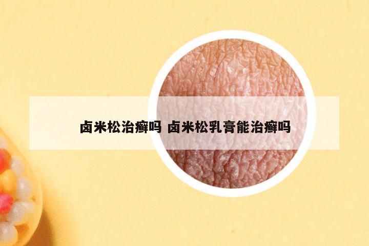 卤米松治癣吗 卤米松乳膏能治癣吗