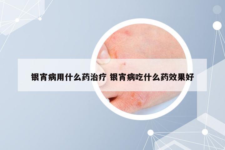 银宵病用什么药治疗 银宵病吃什么药效果好