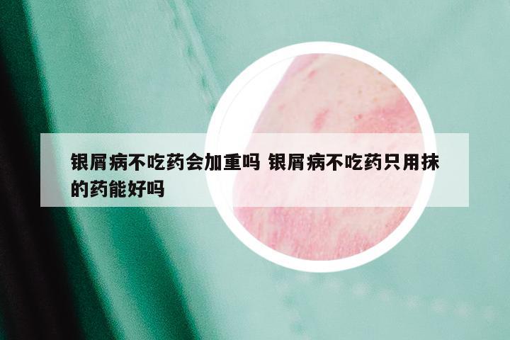银屑病不吃药会加重吗 银屑病不吃药只用抹的药能好吗