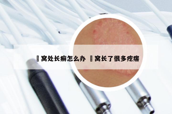 腘窝处长癣怎么办 腘窝长了很多疙瘩
