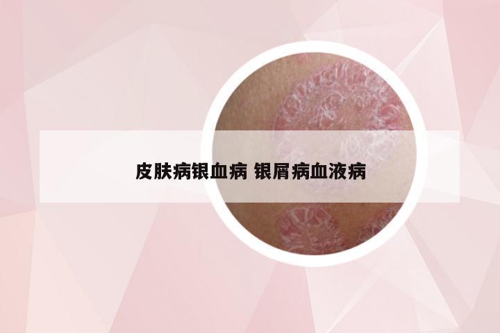 皮肤病银血病 银屑病血液病