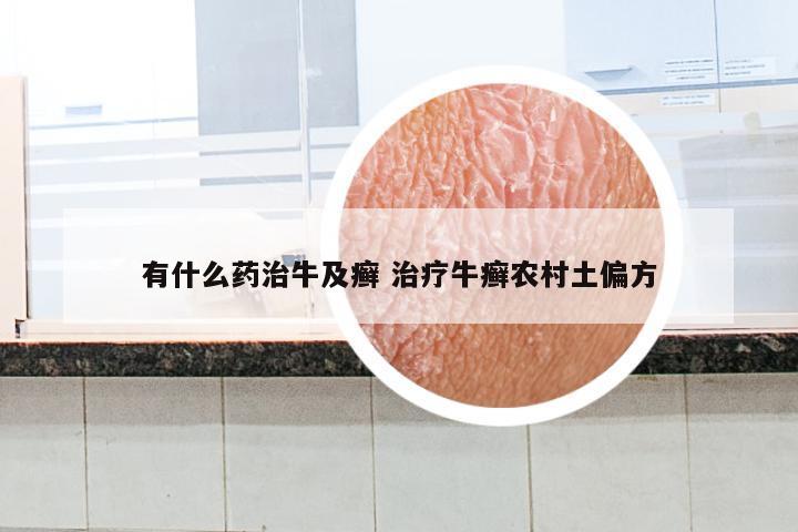 有什么药治牛及癣 治疗牛癣农村土偏方