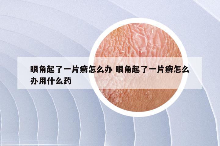 眼角起了一片癣怎么办 眼角起了一片癣怎么办用什么药