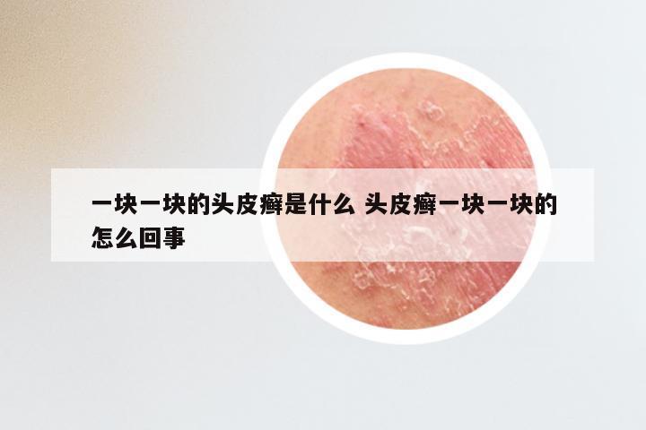 一块一块的头皮癣是什么 头皮癣一块一块的怎么回事