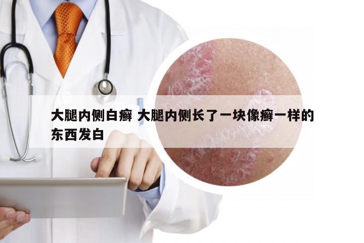 大腿内侧白癣 大腿内侧长了一块像癣一样的东西发白
