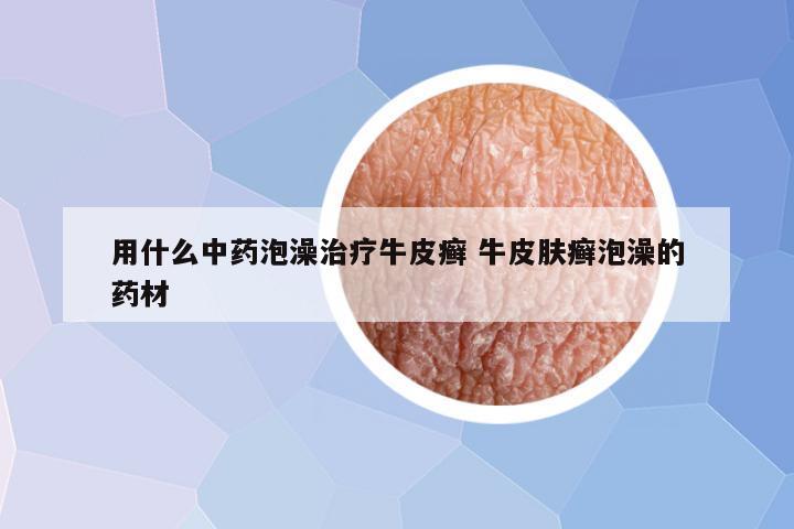 用什么中药泡澡治疗牛皮癣 牛皮肤癣泡澡的药材