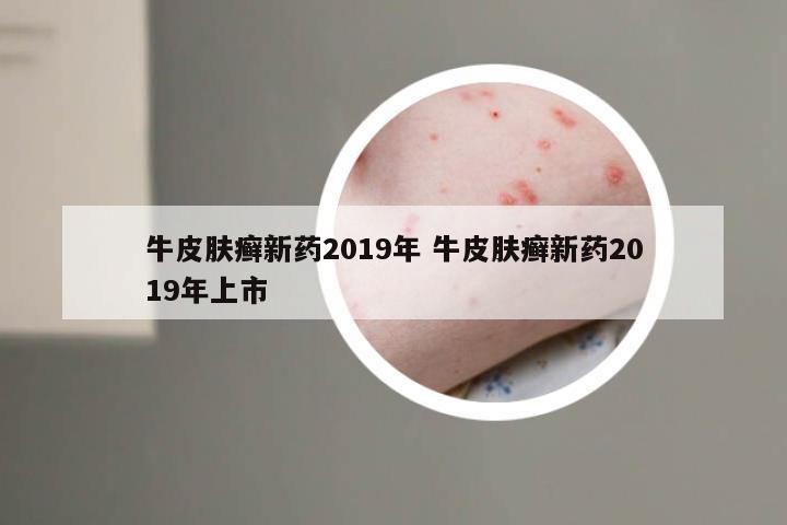 牛皮肤癣新药2019年 牛皮肤癣新药2019年上市