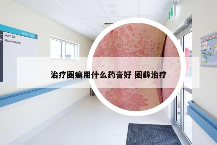 治疗圈癣用什么药膏好 圈藓治疗