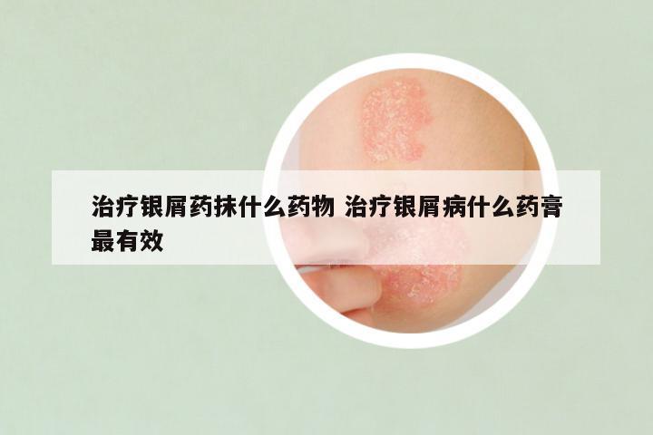治疗银屑药抹什么药物 治疗银屑病什么药膏最有效