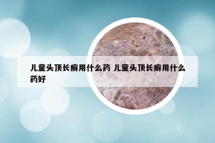 儿童头顶长癣用什么药 儿童头顶长癣用什么药好