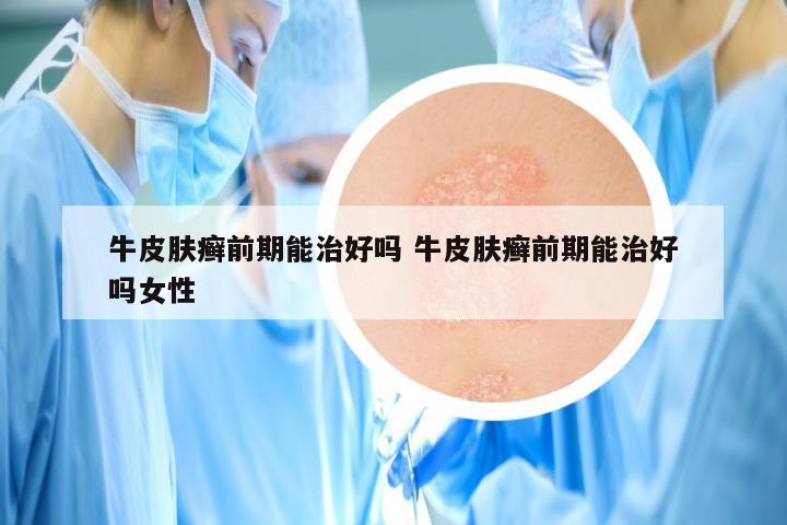 牛皮肤癣前期能治好吗 牛皮肤癣前期能治好吗女性