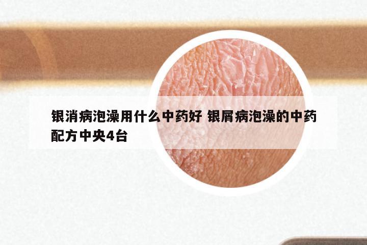 银消病泡澡用什么中药好 银屑病泡澡的中药配方中央4台