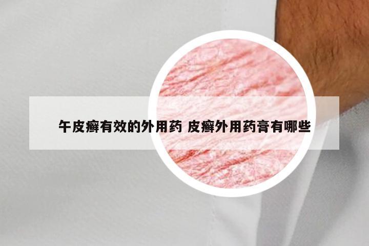 午皮癣有效的外用药 皮癣外用药膏有哪些