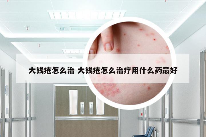 大钱疮怎么治 大钱疮怎么治疗用什么药最好