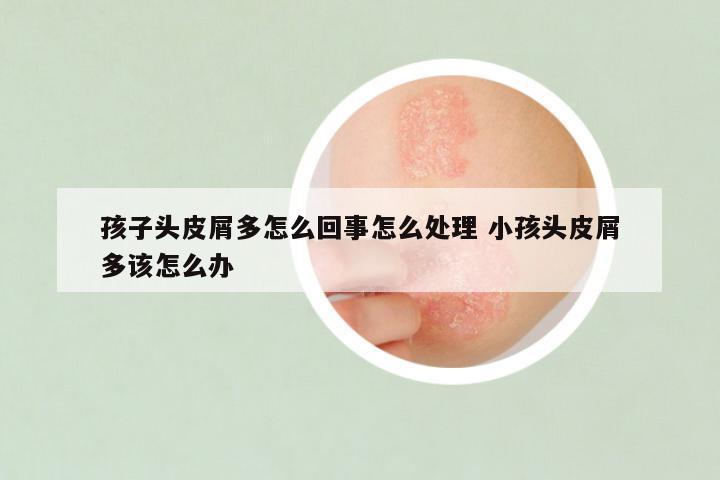 孩子头皮屑多怎么回事怎么处理 小孩头皮屑多该怎么办