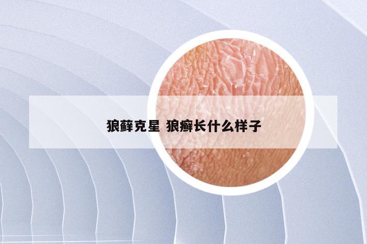 狼藓克星 狼癣长什么样子
