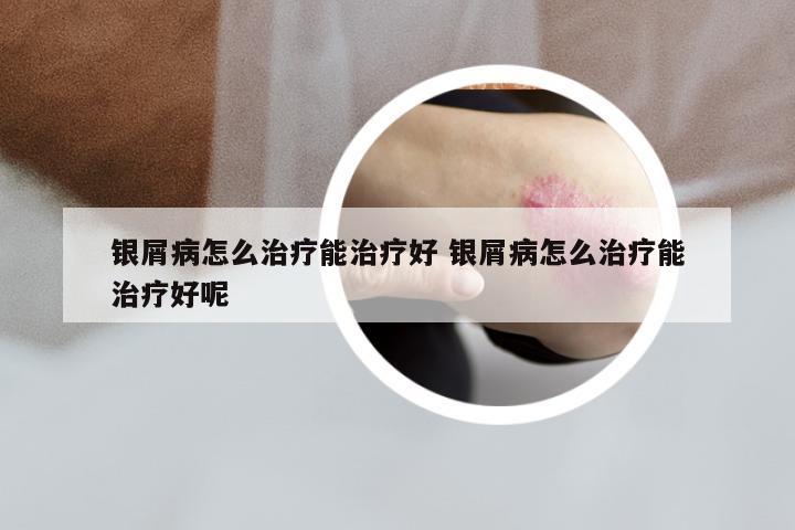 银屑病怎么治疗能治疗好 银屑病怎么治疗能治疗好呢