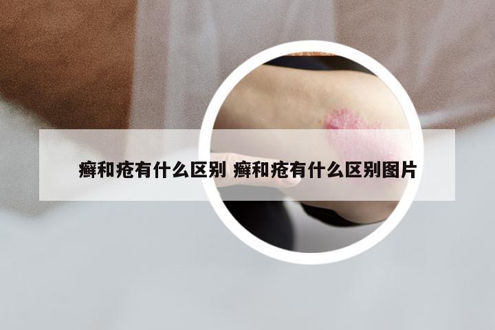 癣和疮有什么区别 癣和疮有什么区别图片