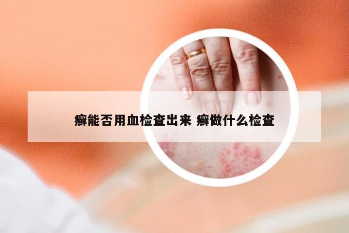 癣能否用血检查出来 癣做什么检查