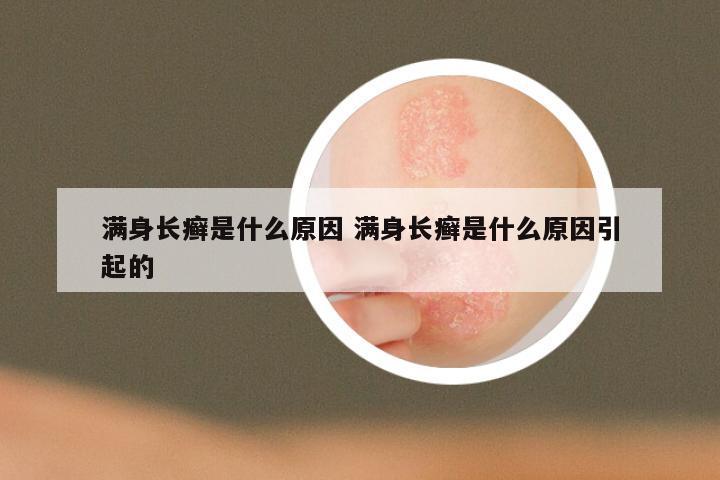 满身长癣是什么原因 满身长癣是什么原因引起的