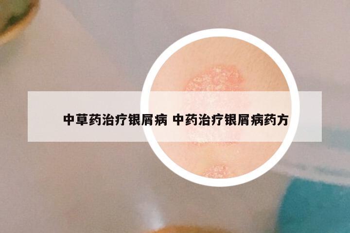 中草药治疗银屑病 中药治疗银屑病药方