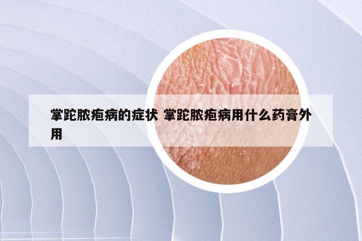 掌跎脓疱病的症状 掌跎脓疱病用什么药膏外用