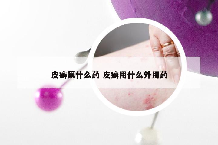 皮癣摸什么药 皮癣用什么外用药