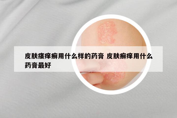 皮肤瘙痒癣用什么样的药膏 皮肤癣痒用什么药膏最好