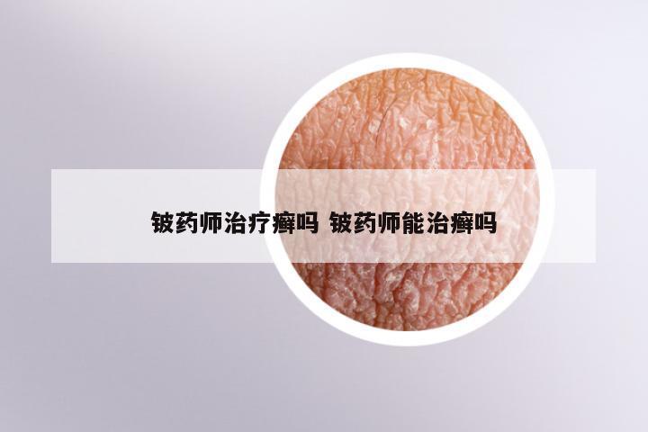 铍药师治疗癣吗 铍药师能治癣吗