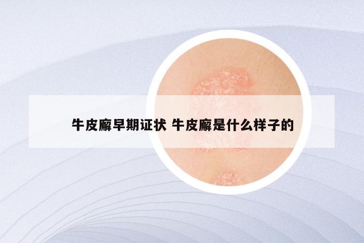 牛皮廨早期证状 牛皮廨是什么样子的