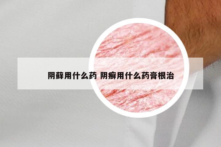 阴藓用什么药 阴癣用什么药膏根治