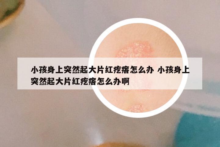 小孩身上突然起大片红疙瘩怎么办 小孩身上突然起大片红疙瘩怎么办啊