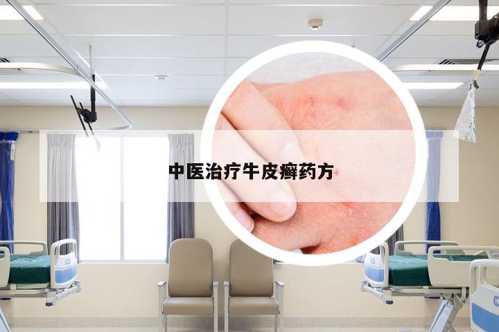 中医治疗牛皮癣药方