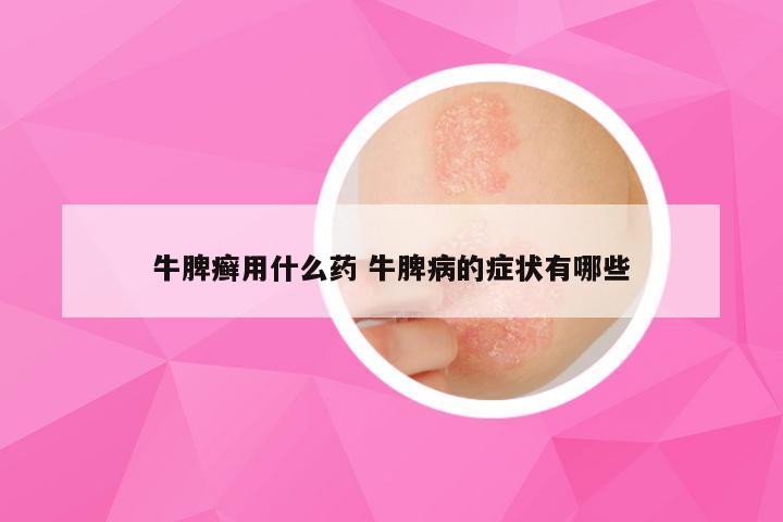 牛脾癣用什么药 牛脾病的症状有哪些