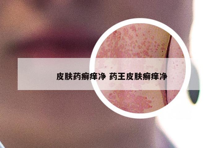皮肤药癣痒净 药王皮肤癣痒净