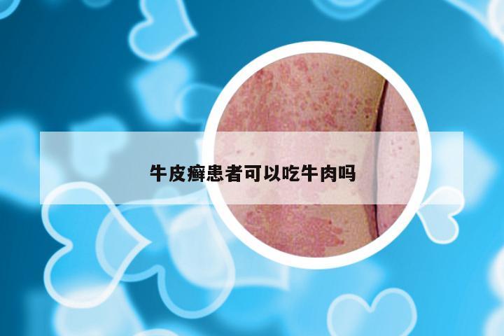 牛皮癣患者可以吃牛肉吗