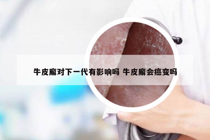 牛皮廨对下一代有影响吗 牛皮廨会癌变吗
