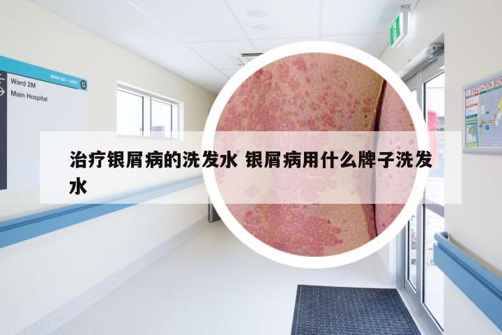 治疗银屑病的洗发水 银屑病用什么牌子洗发水