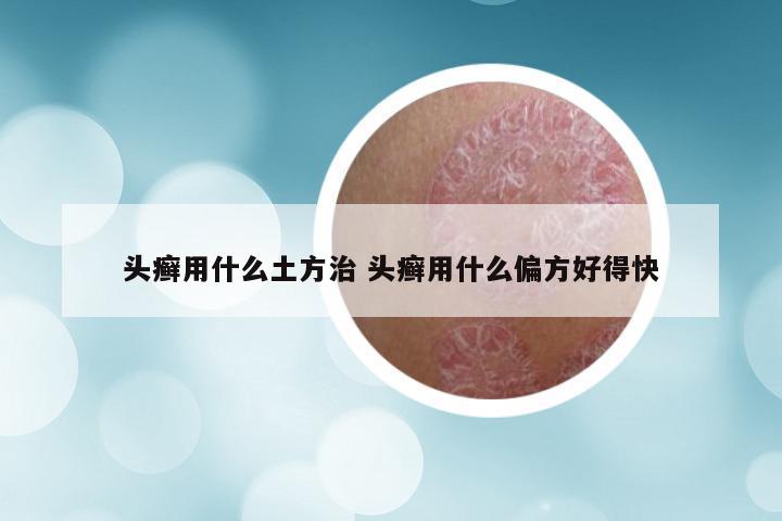 头癣用什么土方治 头癣用什么偏方好得快