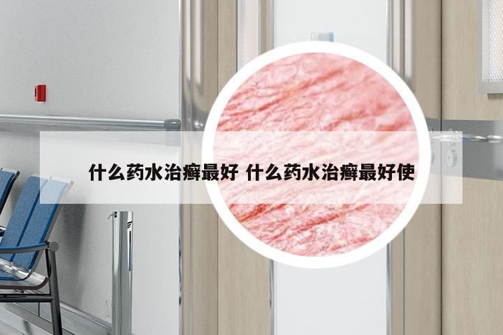 什么药水治癣最好 什么药水治癣最好使