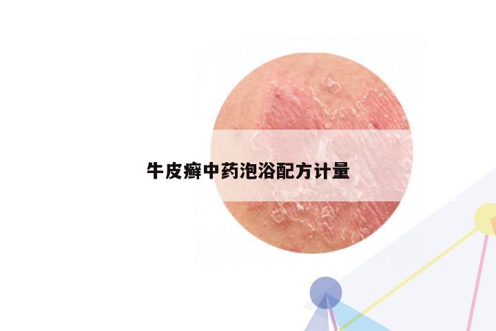 牛皮癣中药泡浴配方计量