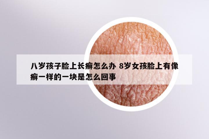 八岁孩子脸上长癣怎么办 8岁女孩脸上有像癣一样的一块是怎么回事