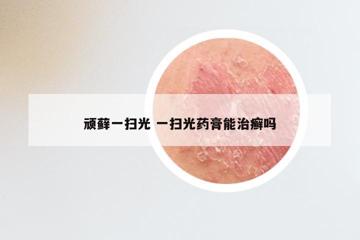 顽藓一扫光 一扫光药膏能治癣吗