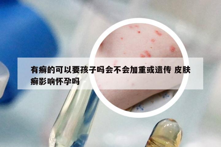 有癣的可以要孩子吗会不会加重或遗传 皮肤癣影响怀孕吗